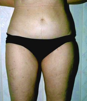 Liposuction Case 3408 After Photo Liposuction