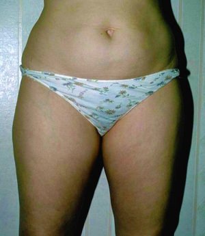 Liposuction