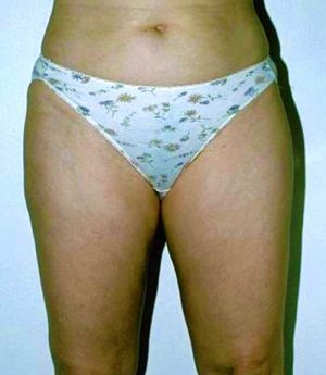 Liposuction