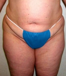 Obese body wearing surgical underwear, Liposuction, Dallas TX