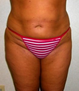 Overweight body wearing a red and white stripes underwear, Liposuction, Dallas TX