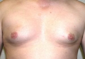 Gynecomastia (Male Breast Reduction)