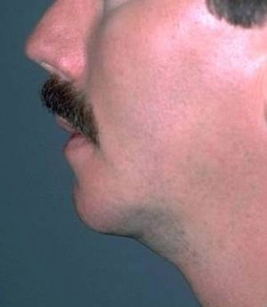 Male Chin Augmentation