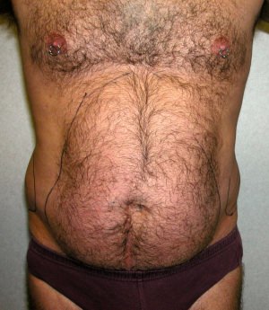 Male Liposuctions