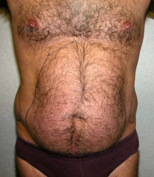 Male Liposuctions Case 3120 Before Photo Male Liposuctions