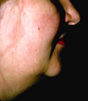 Liposuction of Neck