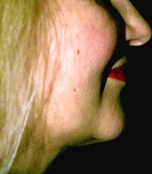 Liposuction of Neck