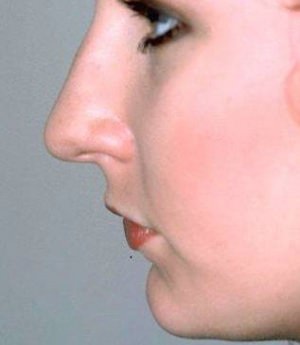 Rhinoplasty