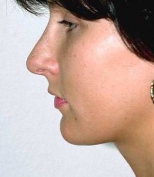 Rhinoplasty