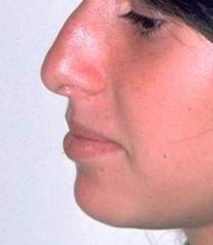 Rhinoplasty