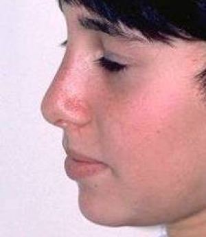 Rhinoplasty