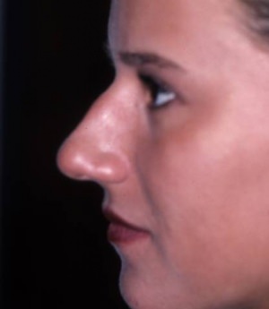 Rhinoplasty