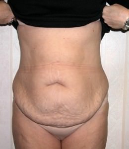 Tummy Tuck Result Dallas