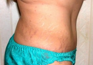 Tummy Tuck (Abdominoplasty)