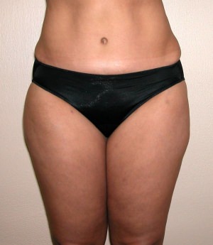 Tummy Tuck (Abdominoplasty)