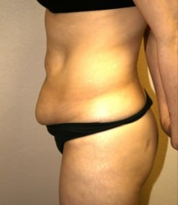 Tummy Tuck Result Dallas