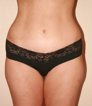 Tummy Tuck (Abdominoplasty)