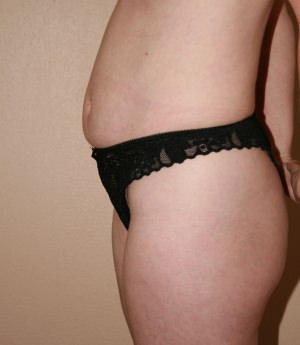 Tummy Tuck (Abdominoplasty)