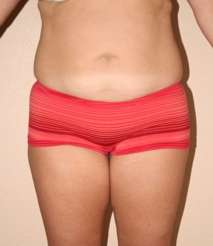 Tummy Tuck (Abdominoplasty)