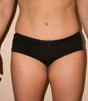 Tummy Tuck (Abdominoplasty)