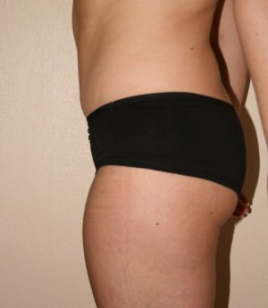 Tummy Tuck (Abdominoplasty)