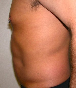 Male Liposuctions Case 3120 After Photo Male Liposuctions