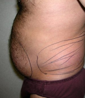 Male Liposuctions Case 3120 Before Photo Male Liposuctions