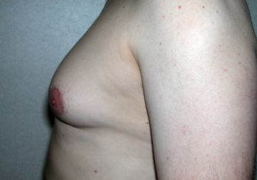 Gynecomastia (Male Breast Reduction)