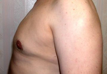 Gynecomastia (Male Breast Reduction)