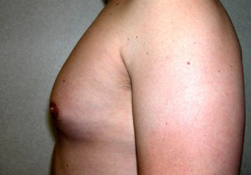 Gynecomastia (Male Breast Reduction)