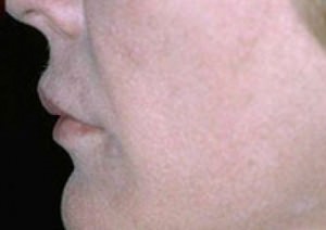 Cheek Augmentation