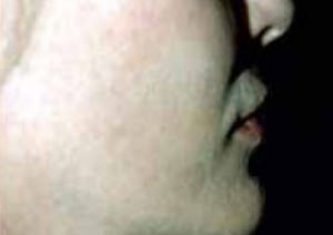 Cheek Augmentation