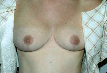 Breast Reduction