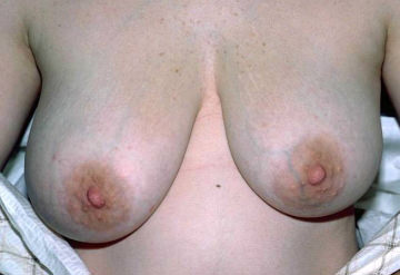 Breast Reduction