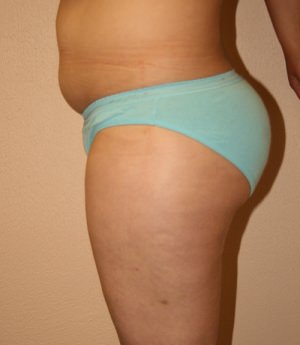 Liposuction