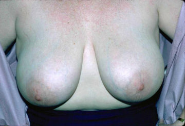 Breast Reduction