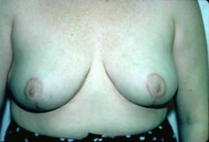 Breast Reduction