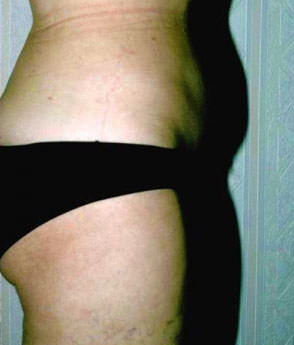 Liposuction Case 3408 After Photo Liposuction