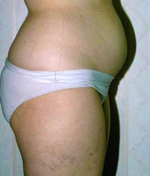 Liposuction Case 3408 Before Photo Liposuction
