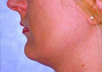 Liposuction of Neck