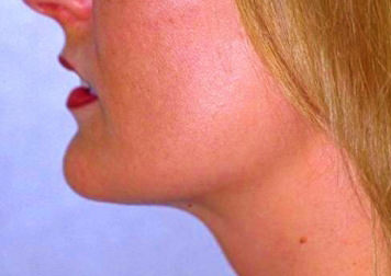 Liposuction of Neck