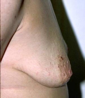 Breast Lift / Mastopexy