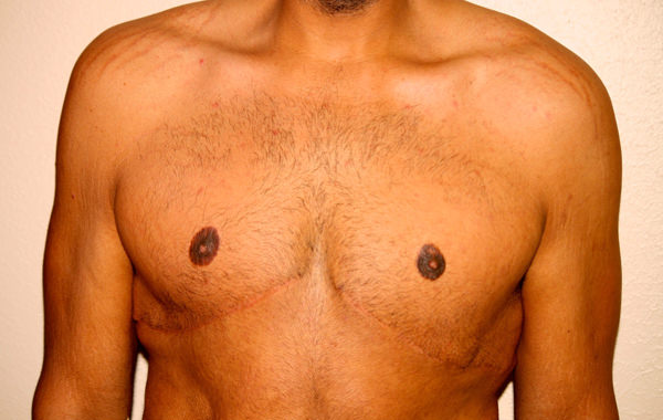 Gynecomastia (Male Breast Reduction)