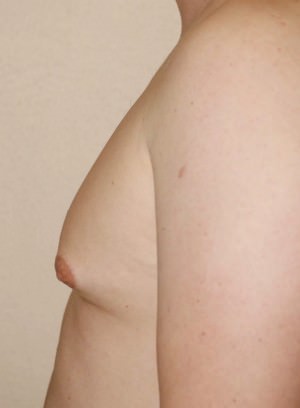 Gynecomastia (Male Breast Reduction)