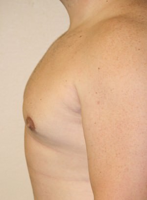 Gynecomastia (Male Breast Reduction)