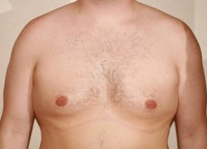 Gynecomastia (Male Breast Reduction)