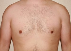 Gynecomastia (Male Breast Reduction)