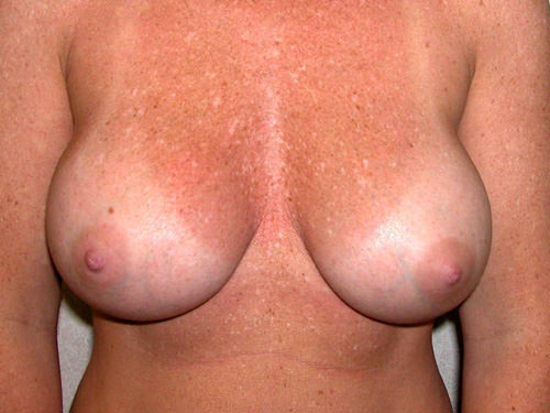 Breast Revision