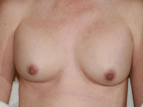 Breast Revision