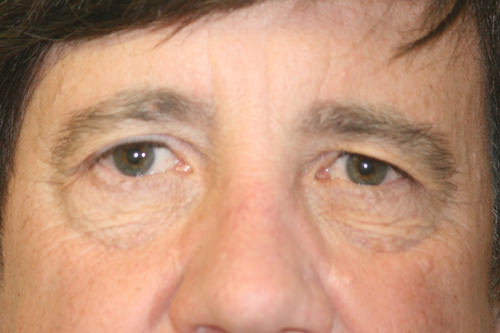 Male Eyelid Surgery (Blepheroplasty)